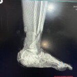 Landmine tore Russian soldier's foot