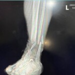 Landmine tore Russian soldier's foot
