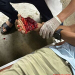 Man lost his hand in workplace accident