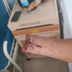 Man lost his hand in workplace accident