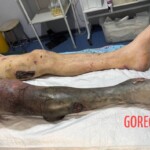 Necrotic leg of Russian soldier