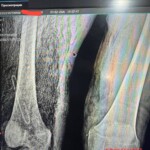 Necrotic leg of Russian soldier