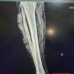 Necrotic leg of Russian soldier