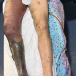 Necrotic leg of Russian soldier