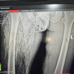 Necrotic leg of Russian soldier
