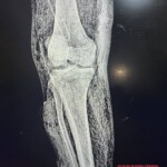 Necrotic leg of Russian soldier