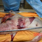 Fall from building killed her and tore off her leg