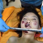Fall from building killed her and tore off her leg