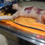 Fall from building killed her and tore off her leg