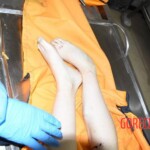 Fall from building killed her and tore off her leg