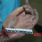 Initial examination of female suicide victim