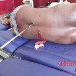 MIX: Victims of Papuan tribal wars