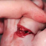 Woman amputated her middle toe