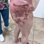 Woman scalded with hot water by her abusive boyfriend