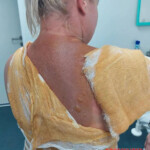 Woman scalded with hot water by her abusive boyfriend